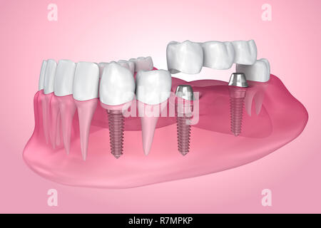 Impianto supportato fisso bridge. Una vista trasparente . Accurata dal punto di vista medico 3D illustrazione Foto Stock