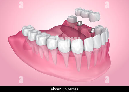 Impianto supportato fisso bridge. Una vista trasparente . Accurata dal punto di vista medico 3D illustrazione Foto Stock