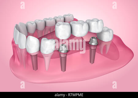 Impianto supportato fisso bridge. Una vista trasparente . Accurata dal punto di vista medico 3D illustrazione Foto Stock