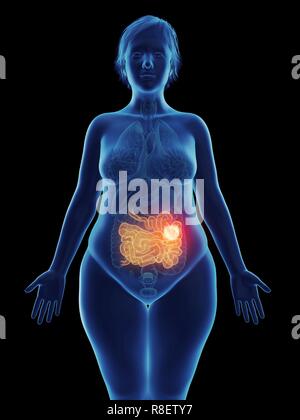 Illustrazione di un tumore in una donna del piccolo intestino. Foto Stock