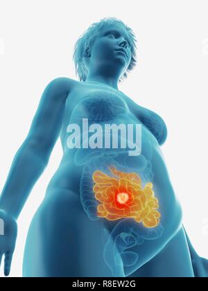 Illustrazione di un tumore in una donna del piccolo intestino. Foto Stock