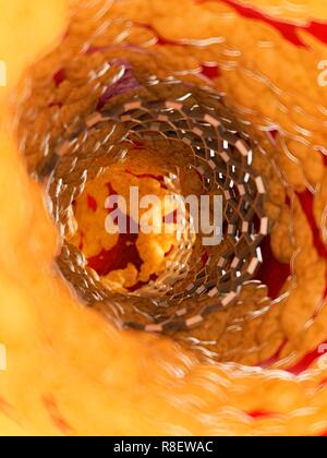 Illustrazione di uno stent all'interno di una arteria. Foto Stock