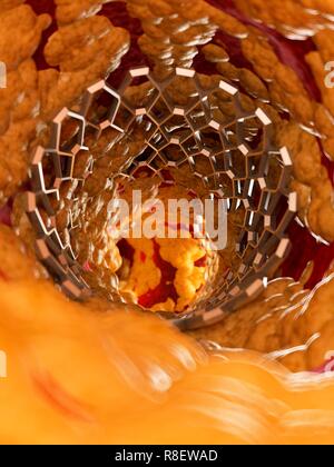 Illustrazione di uno stent all'interno di una arteria grassi. Foto Stock