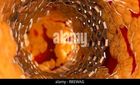 Illustrazione di uno stent all'interno di una arteria grassi. Foto Stock