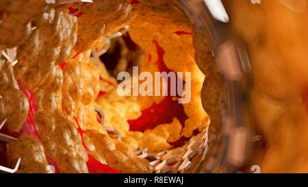 Illustrazione di uno stent all'interno di una arteria grassi. Foto Stock