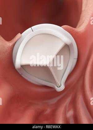 Illustrazione di una valvola cardiaca artificiale. Foto Stock