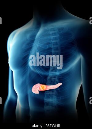 Illustrazione di un uomo di tumore del pancreas. Foto Stock