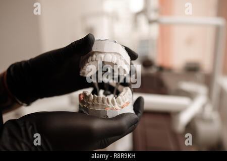 Calco in gesso delle ganasce. Dentista in guanti neri azienda Dental casting modello in gesso ganasce umano in laboratorio protesico. Odontoiatria, ortodonzia. Chiudere Foto Stock