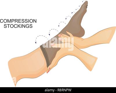 Illustrazione vettoriale di medicazione calza di compressione sulla gamba. Illustrazione Vettoriale