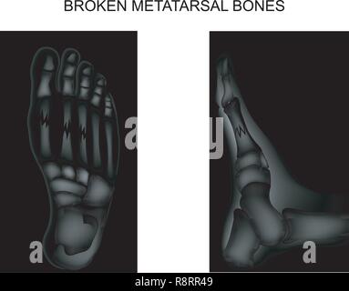 Illustrazione vettoriale delle fratture delle ossa metatarsica del piede Illustrazione Vettoriale
