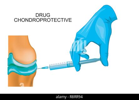 Illustrazione vettoriale di una soluzione iniettabile di trattamento dei giunti Illustrazione Vettoriale