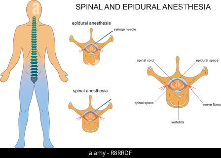 Illustrazione vettoriale di e epidurale anestesia spinale Illustrazione Vettoriale