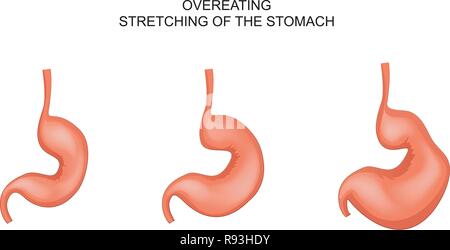 Illustrazione vettoriale di un stomaco teso da surriscaldamenti Illustrazione Vettoriale