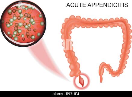 Illustrazione vettoriale di appendicite acuta. batteri, infiammazione Illustrazione Vettoriale