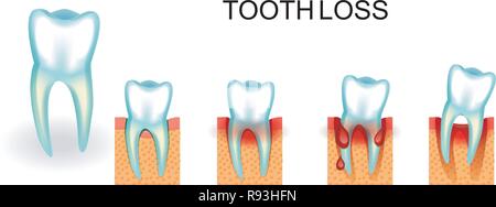 Illustrazione vettoriale di sani e malati dente. sanguinamento delle gengive. Perdita dei denti Illustrazione Vettoriale