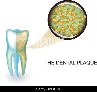 Illustrazione vettoriale di placca dentale. microbi sotto ingrandimento Illustrazione Vettoriale