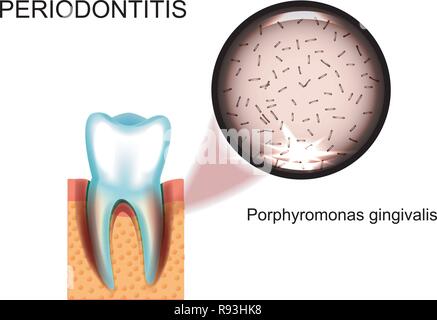 Illustrazione vettoriale della periodontite. Porphyromonas gingivalis. Stomatologia. Illustrazione Vettoriale