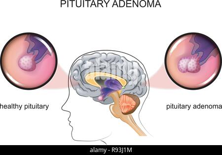 Illustrazione vettoriale di un sano e ipofisi adenoma pituitario Illustrazione Vettoriale