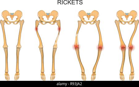 Illustrazione vettoriale di scheletro degli arti inferiori in rachitismo Illustrazione Vettoriale