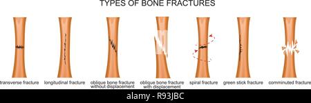 Illustrazione Vettoriale dei tipi di fratture ossee Illustrazione Vettoriale