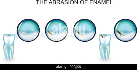 Illustrazione vettoriale di abrasione dello smalto. il dente interessato. Illustrazione Vettoriale