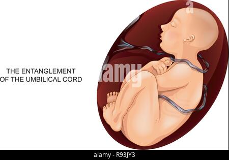 Illustrazione di vettore di entanglement di cordone ombelicale intorno al feto Illustrazione Vettoriale
