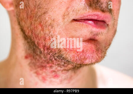 Uomo con dermatite seborroica nell'area della barba Foto Stock