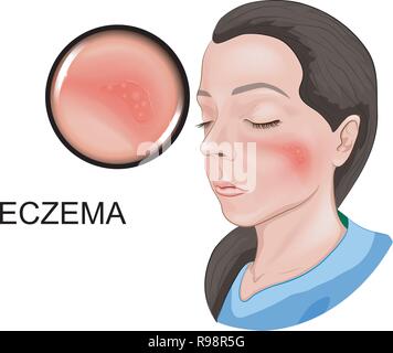 Illustrazione vettoriale di un eczema di una faccia Illustrazione Vettoriale