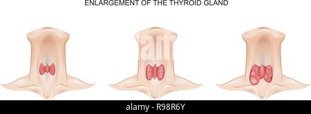 Illustrazione vettoriale di un ingrossamento della ghiandola tiroidea Illustrazione Vettoriale