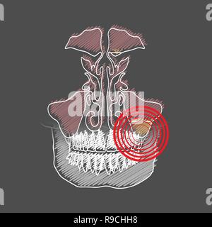 Odontogenic sinusite. Infiammazione dei seni mascellari a causa di una malattia delle radici del dente con un punto di dolore e infiammazione. 10 eps Illustrazione Vettoriale