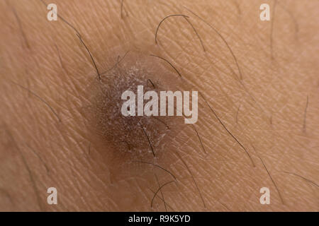 Close up cheloide cicatrice (cicatrice ipertrofica) sulla pelle Foto Stock