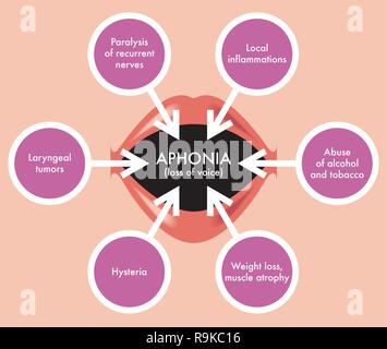 Un medico di schema che illustra Aphonia, la perdita della voce. Illustrazione Vettoriale