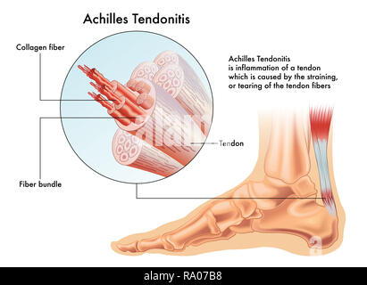 Una illustrazione medica dei sintomi di Achille tendinite o infiammazione del tendine di Achille. Foto Stock