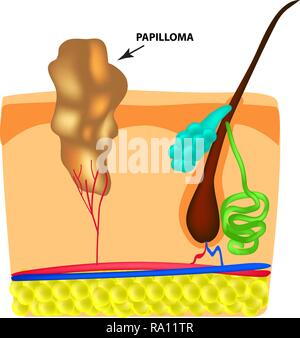 La struttura del papilloma. La struttura della pelle. Infographics. Illustrazione Vettoriale su sfondo isolato Illustrazione Vettoriale