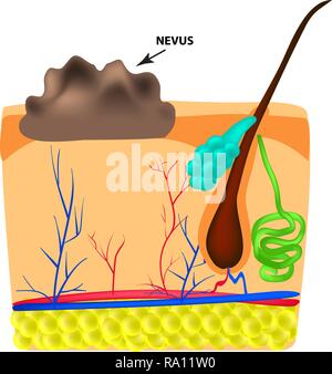 La struttura del nevo. La struttura di moli sulla pelle. Infographics. Illustrazione Vettoriale su sfondo isolato Illustrazione Vettoriale