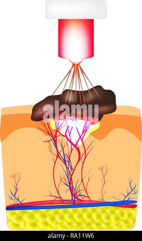 Rimozione di birthmarks, popiloma, verruca laser. La struttura di moli sulla pelle. Infographics. Illustrazione Vettoriale su sfondo isolato Illustrazione Vettoriale