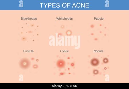 Tutti i tipi di acne appaiono sulla superficie della pelle. Illustrazione Vettoriale