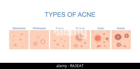 Tipi di acne schema per i problemi della pelle contenuto. Illustrazione Vettoriale