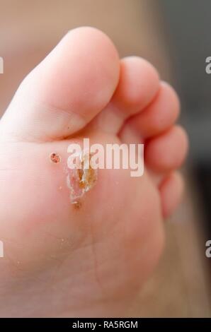Verruca verruca plantare su un bambino il piede, Regno Unito Foto Stock