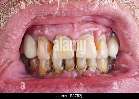 I denti di un uomo anziano sono viziati dalla carie, tartaro e una cattiva nutrizione macro. Il danno di alcool e di tabacco concetto. Studio di ripresa macro Foto Stock