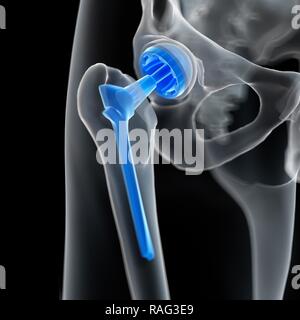 Illustrazione di un'anca. Foto Stock
