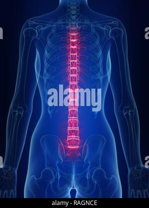 Illustrazione della dolorosa all'indietro. Foto Stock