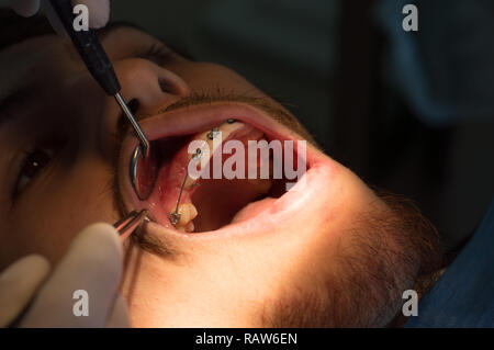 Procedura di ortodonzia. Esposizione di unerupted, dente incluso. Foto Stock