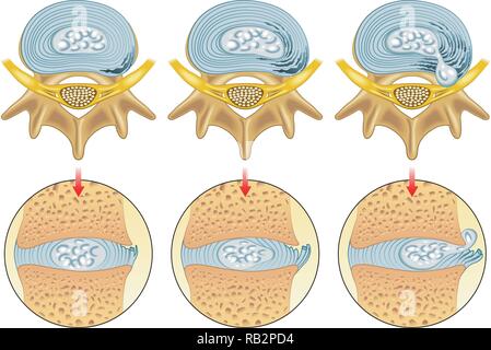 Illustrazione medica degli effetti dell'ernia del disco Illustrazione Vettoriale