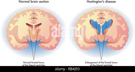 Illustrazione medica dei sintomi della malattia di Huntington nel cervello Illustrazione Vettoriale
