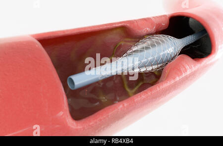 L'aterosclerosi trattamento con stent inserto - 3D Rendering Foto Stock