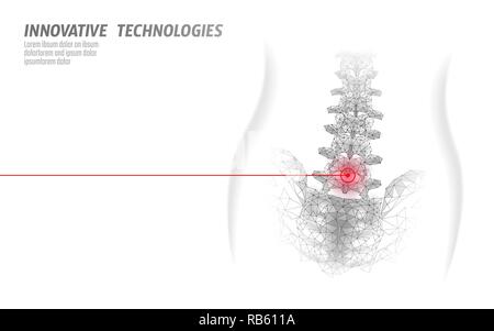 Fisioterapia Laser colonna vertebrale umana. Area di dolore intervento chirurgico medicina moderna tecnologia bassa poli triangoli 3D render femmina ernia posteriore illustrazione vettoriale Illustrazione Vettoriale