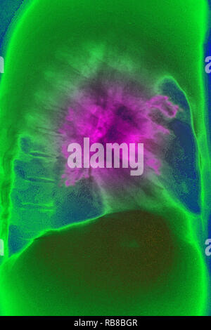 Il cancro del polmone X-RAY Foto Stock