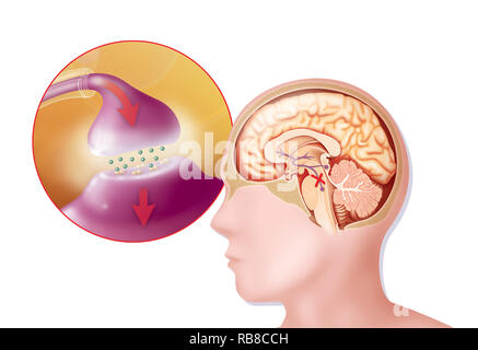 Il Morbo di Parkinson, disegno Foto Stock