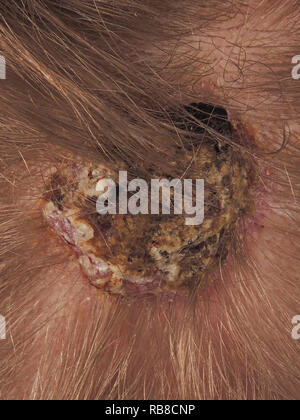 Il carcinoma a cellule basali Foto Stock